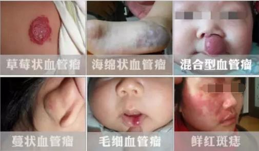 宝宝出现血管瘤怎么办,宝宝得了血管瘤怎么办