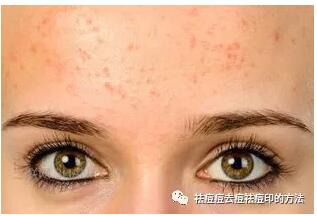 柳芙祛痘印最有效的方法,柳芙祛痘精华怎么样