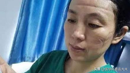 戴口罩时间长了耳朵疼怎么解决,戴口罩防止眼镜起雾最佳方法