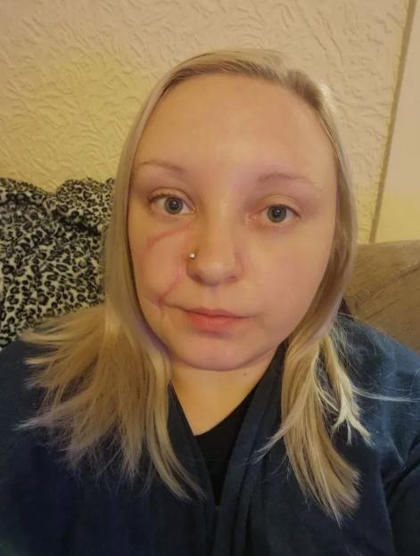 5岁女孩长水痘,成年人长水痘留下红印