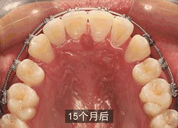 烤瓷牙崩瓷露出里面金属有毒吗,钛合金烤瓷牙有毒吗