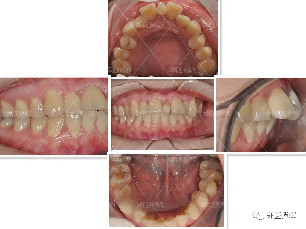 门牙前突牙齿不齐矫正案例分享,门牙和旁边牙齿不齐最快矫正方法