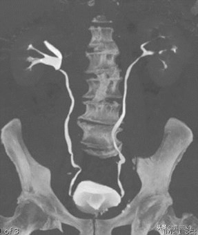 尿路小结石怎么治疗,为什么结石医生不建议做激光