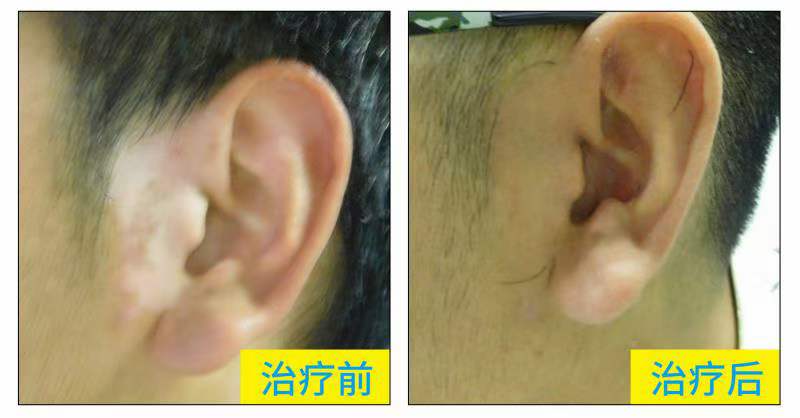 白癜风prp疗法多长时间一个疗程,白癜风光疗一个疗程需要做多少次