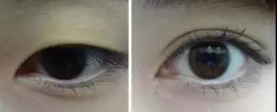 内眼角和外眼角哪个更安全,内眼角和外眼角是什么位置