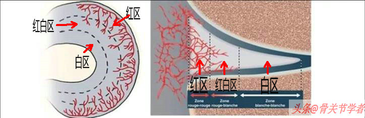 磁共振怎么看半月板损伤程度,磁共振半月板损伤1级是什么