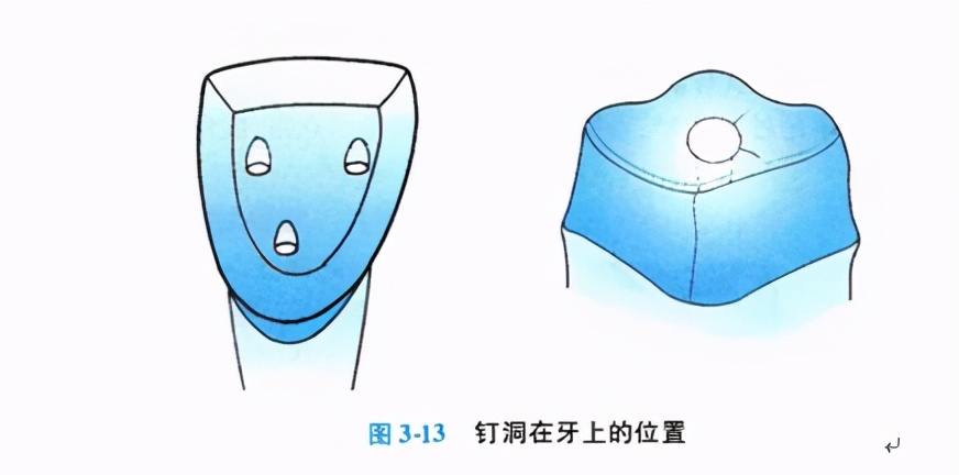 牙齿缺损修复去哪家牙科医院,牙科门牙缺损修复照片