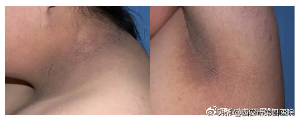 脖子发黑怎么都洗不干净怎么办,脖子发黑洗不掉像脏兮兮怎么办