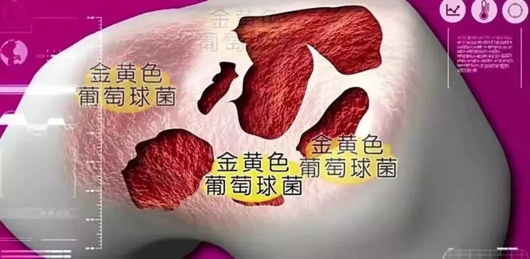 抽关节积液有什么危害,关节积液到底抽还是不抽