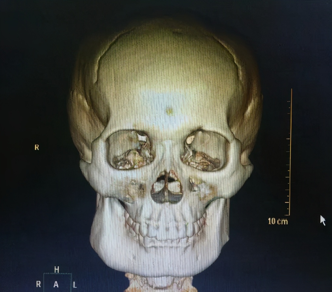 左右脸不对称怎么矫正最好看,如何纠正天生左右脸不对称的问题