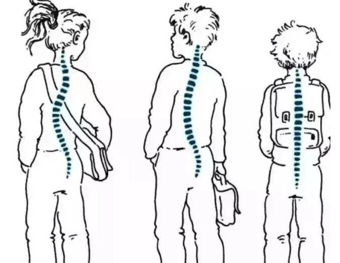 成年人脊柱歪,成年人脊椎弯了怎么办