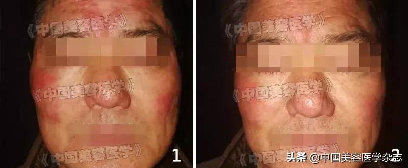 幽门螺杆菌和脂溢性皮炎有关系吗,幽门螺旋杆菌引起口周皮炎