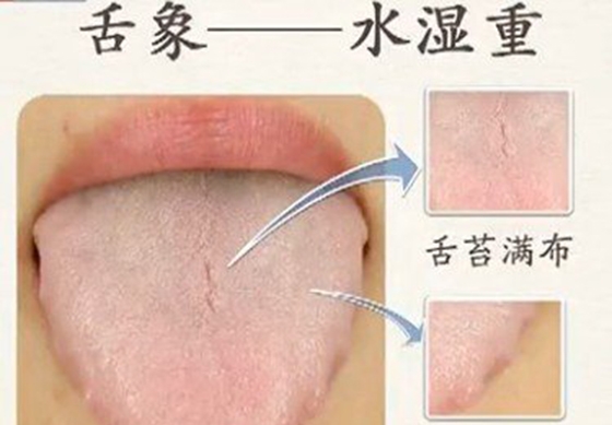 湿气分为湿热和湿寒痰湿,湿气与气虚的关系