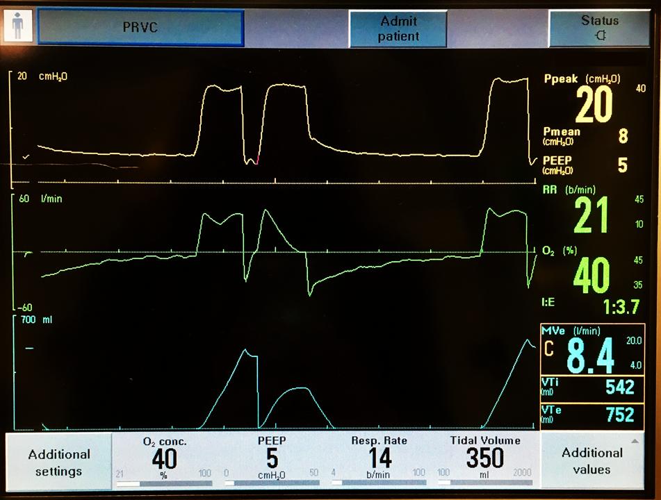 新冠肺炎机械通气系列课程(讲义)-阻塞性肺病的机械通气
