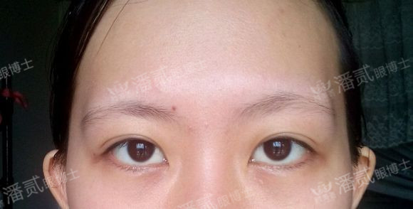 原来双眼皮不好看有必要继续割吗,割双眼皮是不是越修复越难看