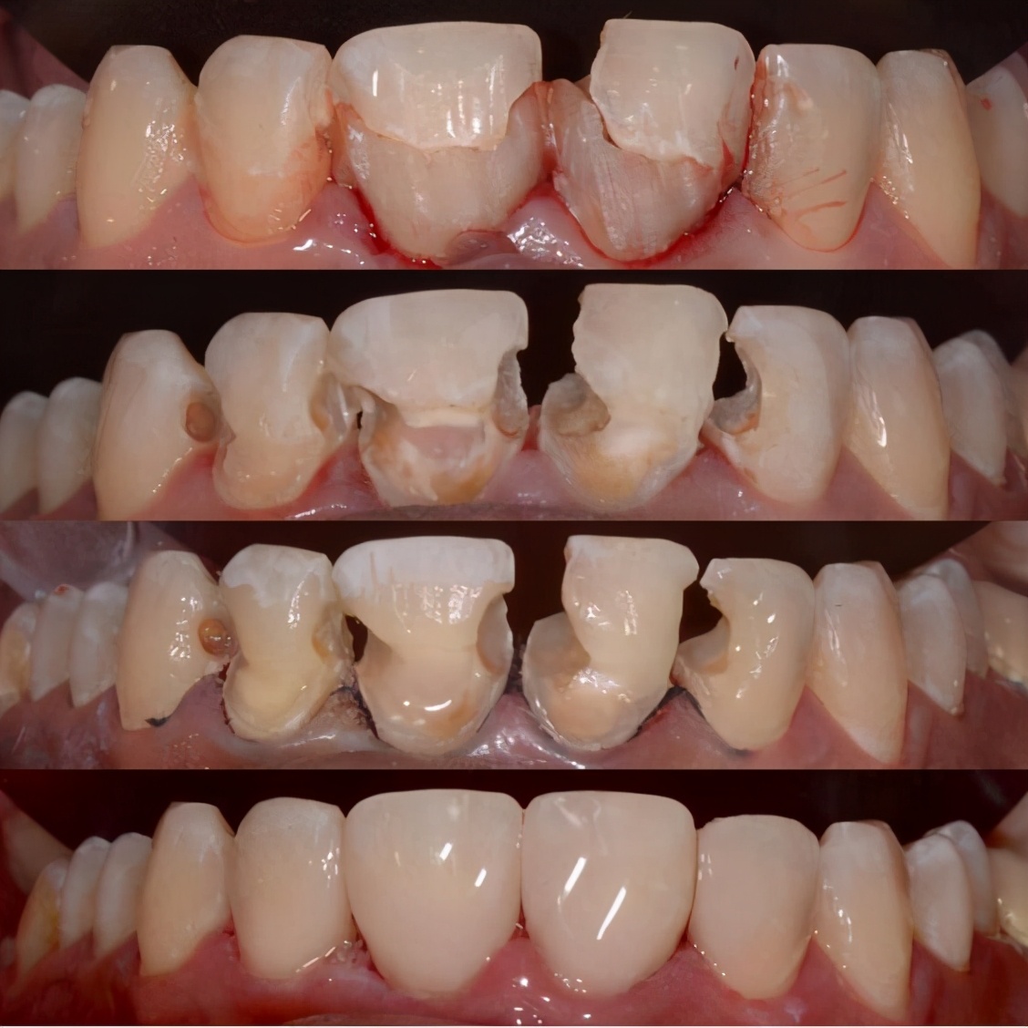 牙体缺损粘接修复术过程,口腔修复学牙体缺损的修复