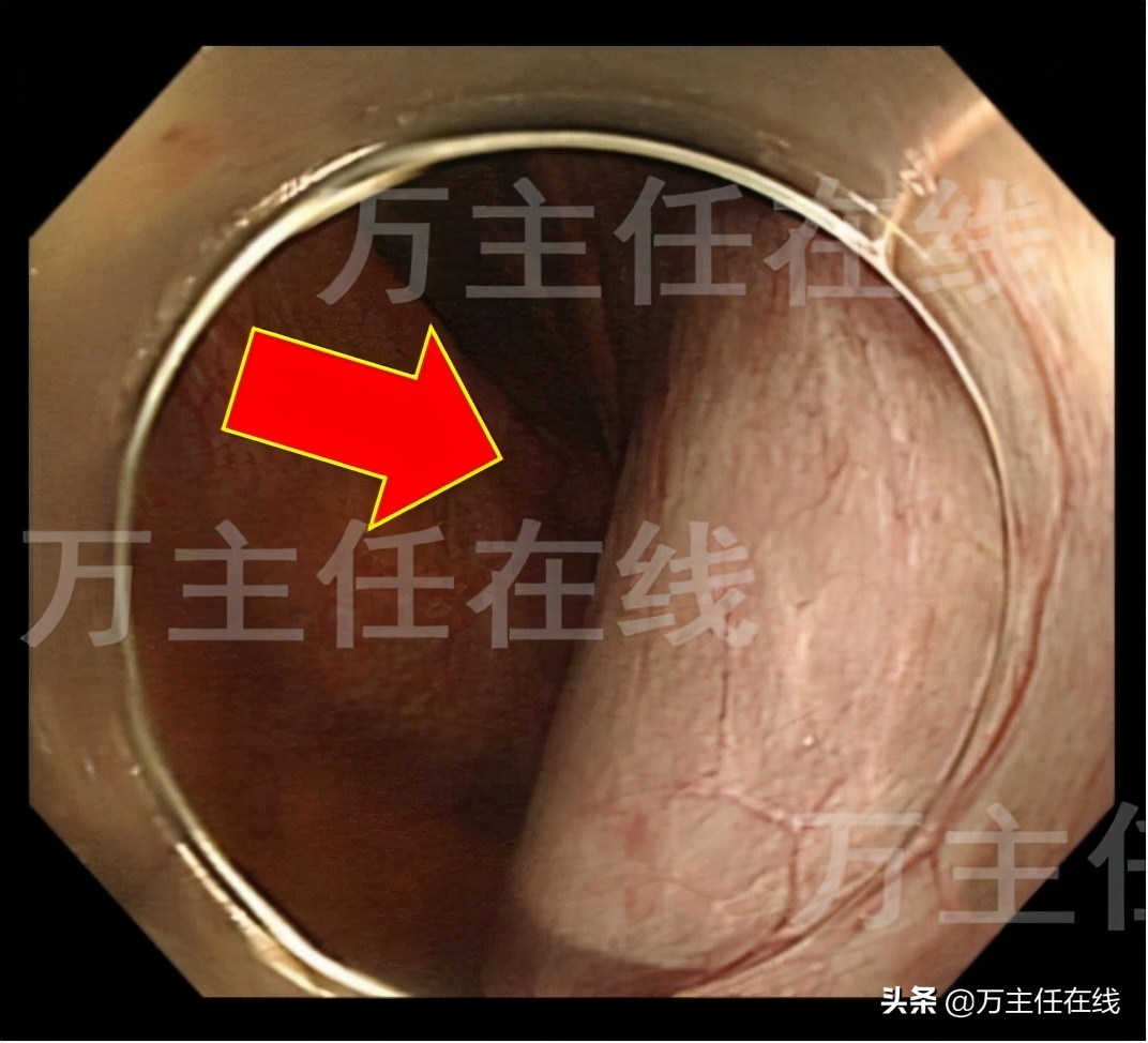 消化内科肝脏手术,肝部囊肿切除手术
