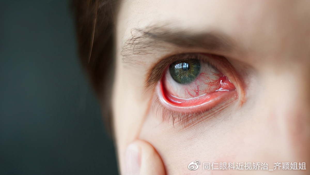 眼病角膜炎和结膜炎症状有何不同,结膜炎角膜炎眼睛为什么会反复红