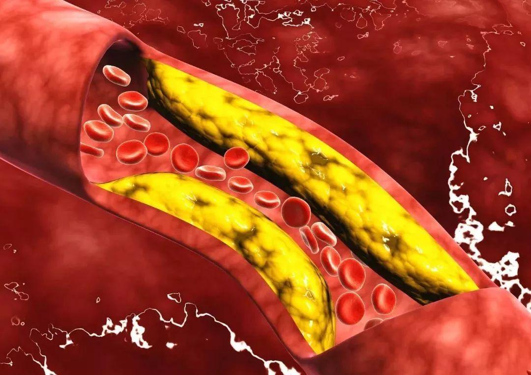 丙酸血症是怎么引起的啊,丙酸血症是什么意思