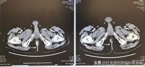 肛肠难言之隐,直肠癌常见的转移部位