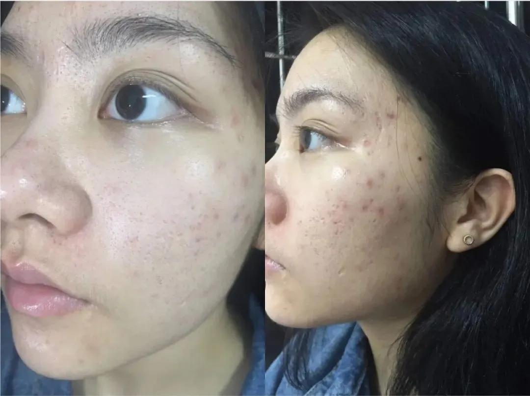 片仔癀痘痘贴效果怎么样,片仔癀清痘系列真的有用嘛