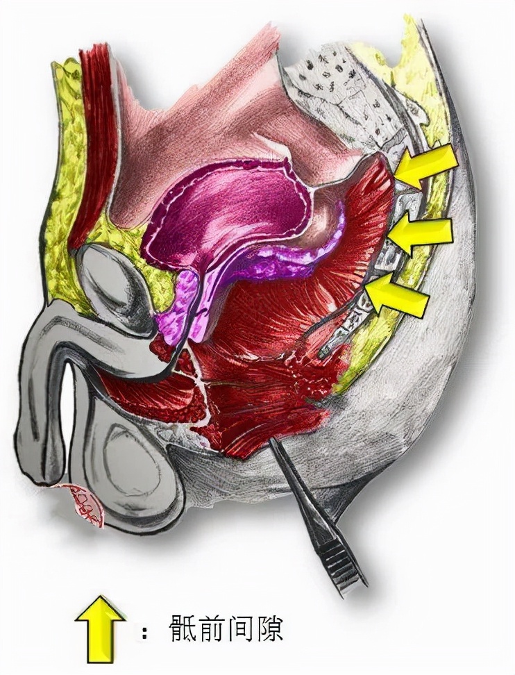 臀部里长了个硬硬的瘤子,臀部上长个瘤子不疼不痒软软的
