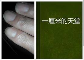胆结石20mm怎么治好,胆结石6mm有多大需不需要手术