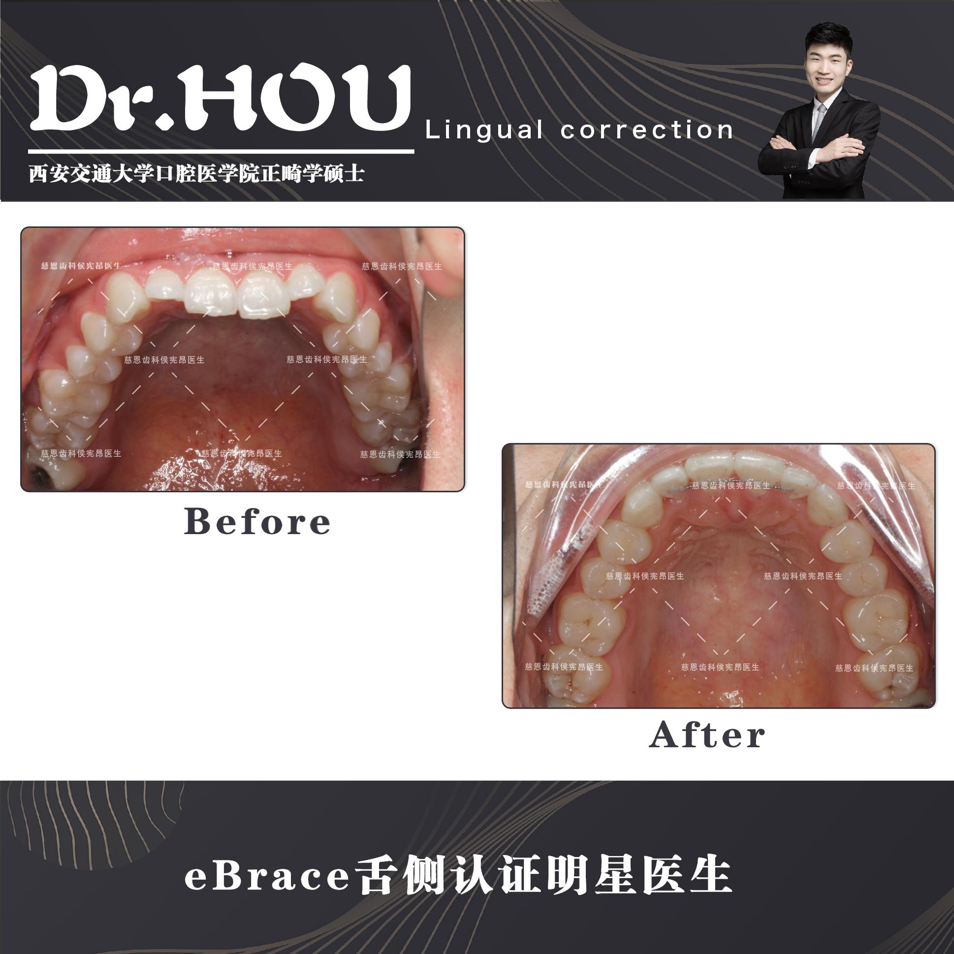 地包天的牙齿图片,牙齿地包天怎么补救