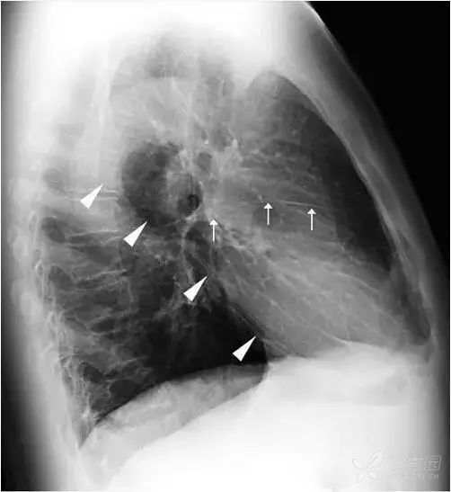 正常胸片图片,正常的胸片讲解