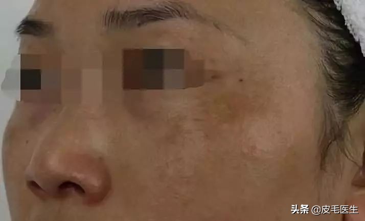 雀斑黄褐斑老年斑祛斑方法,褐斑老年斑怎么治疗效果最好