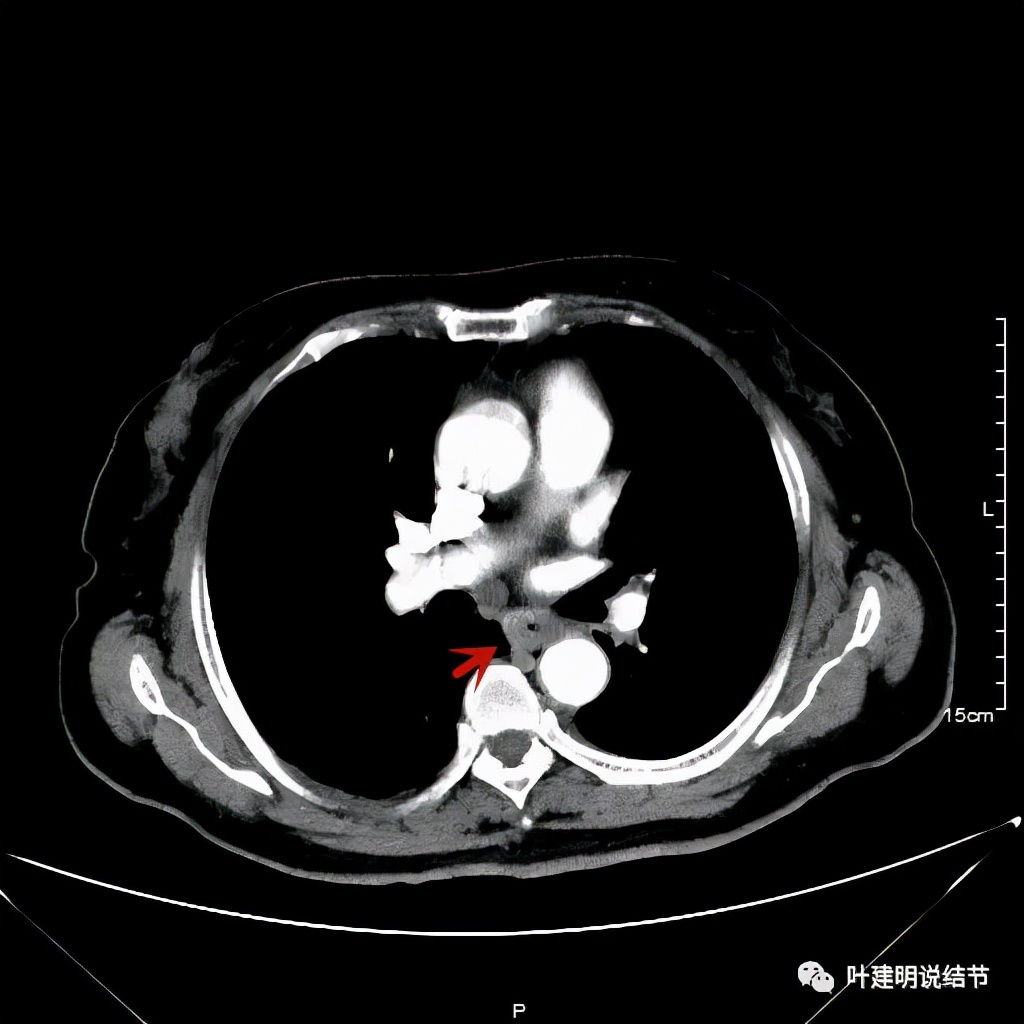 特瑞普利单抗食管癌成功案例,特瑞普利单抗治疗食管癌效果好吗