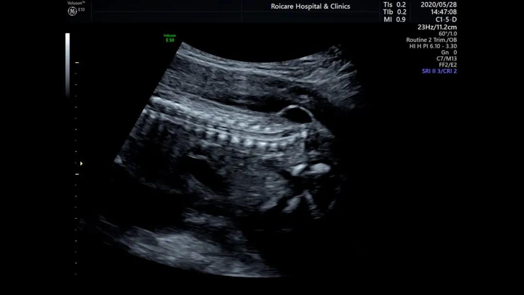 胎儿期发现脊髓圆锥位置低的临床指导