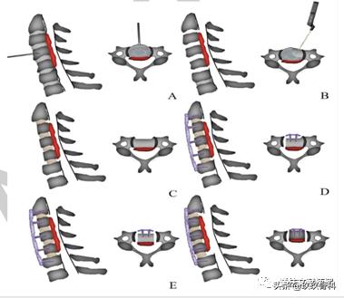 acaf手术适应脊髓型颈椎病吗,acaf术后康复方法