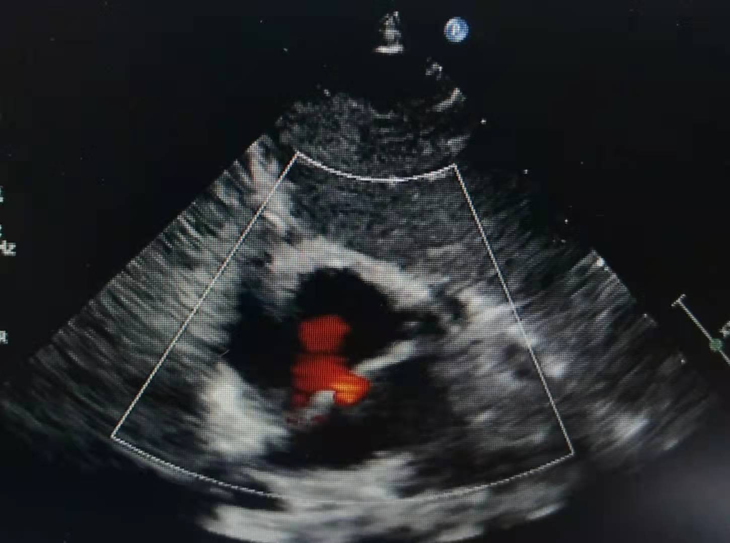 川崎病婴儿自述,3岁女童确诊死亡