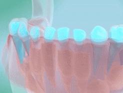 恒牙出来多久了乳牙未掉需要拔牙,孩子乳牙未掉用干预吗