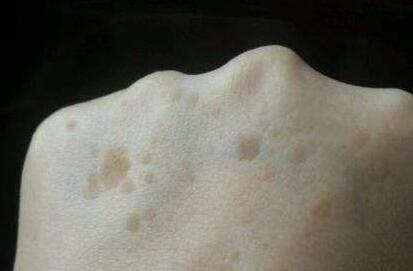 像老年斑一样的扁平疣怎么治,像斑一样的扁平疣