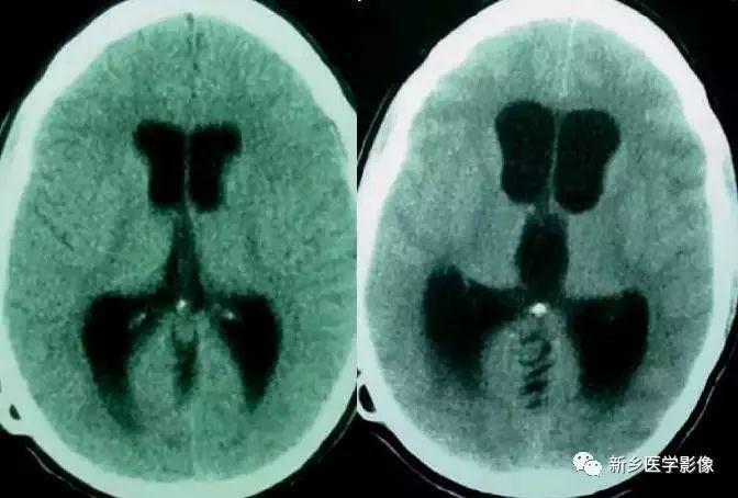 什么引起成人脑室扩大,哪些病可以导致左侧脑室增宽