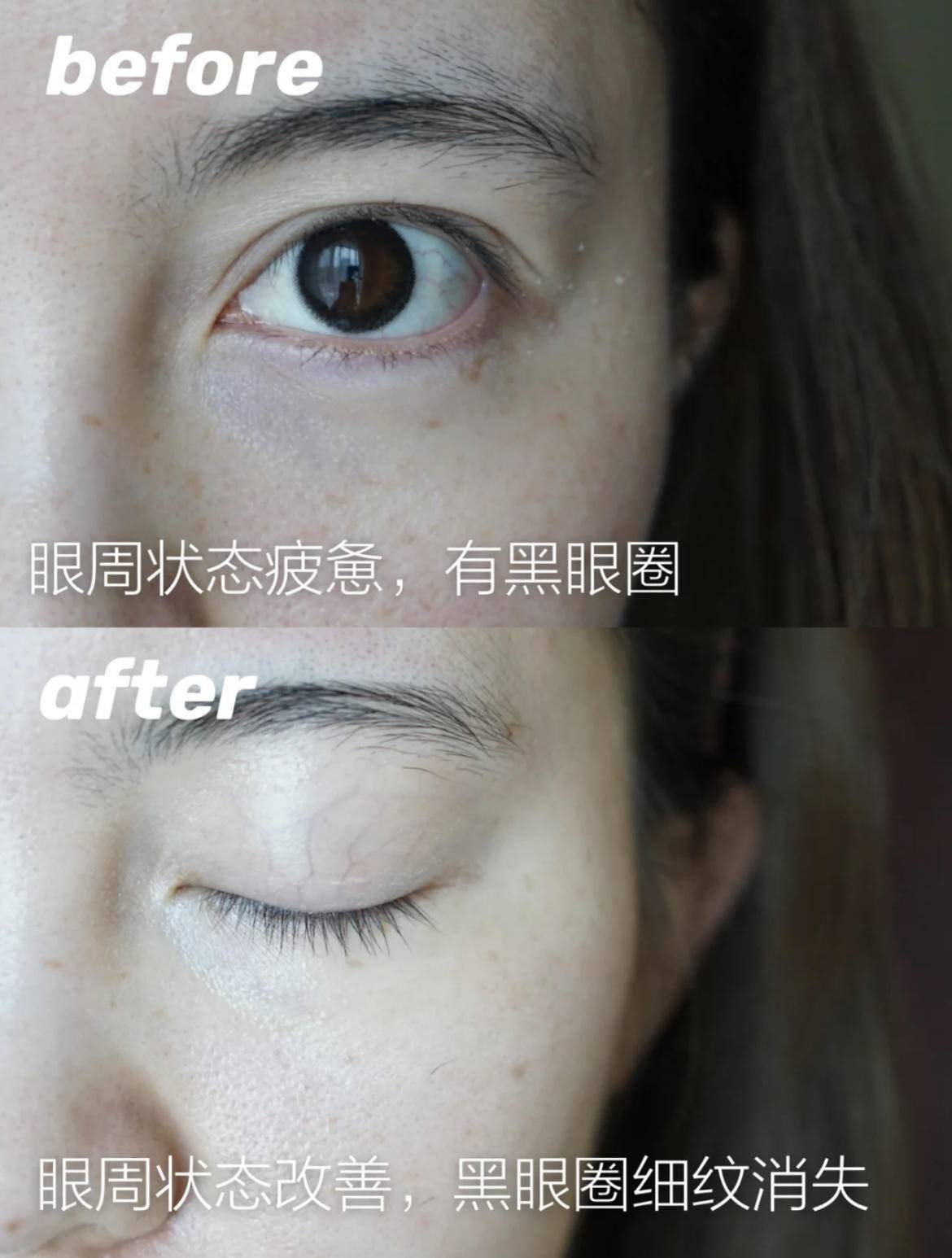 如何有效改善眼周水肿,眼水肿了怎么消肿