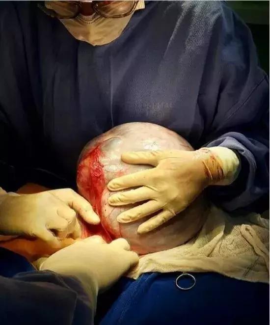 卵巢囊肿怎么治疗最好中医,女人卵巢囊肿的原因及治疗