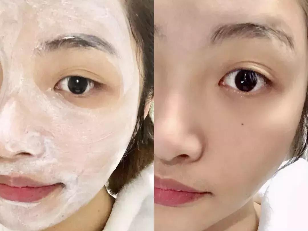 日本复活草面膜敷完后长闭口,日本复活草面膜晒后修复