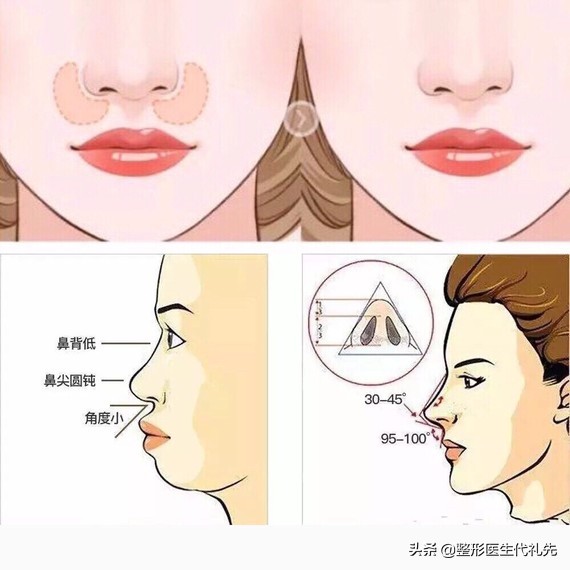 从医学来讲法令纹怎么改善比较好,整形医生怎么解决法令纹的问题