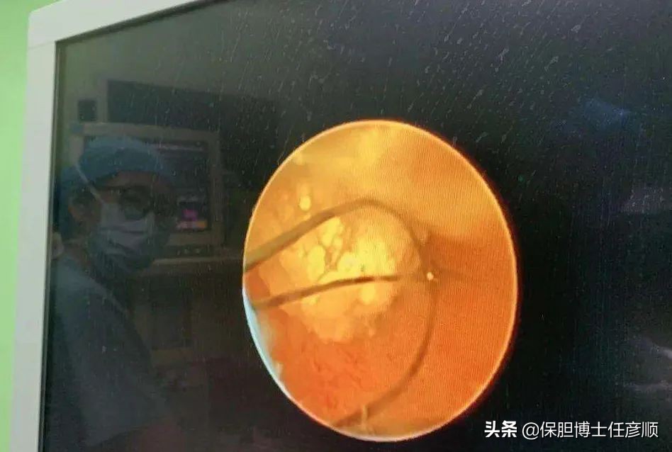 胆囊息肉腹腔镜手术多少钱,胆囊息肉切除手术费用明细