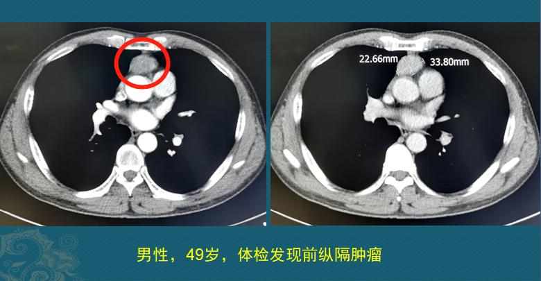 为什么每年体检还会查出癌症晚期,年年体检正常却被诊断为癌症晚期