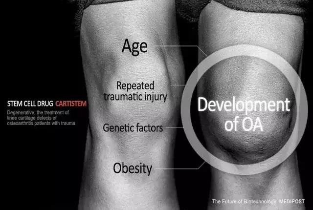 为什么干细胞成为治疗关节疼痛的最佳选择，来看看这些实例