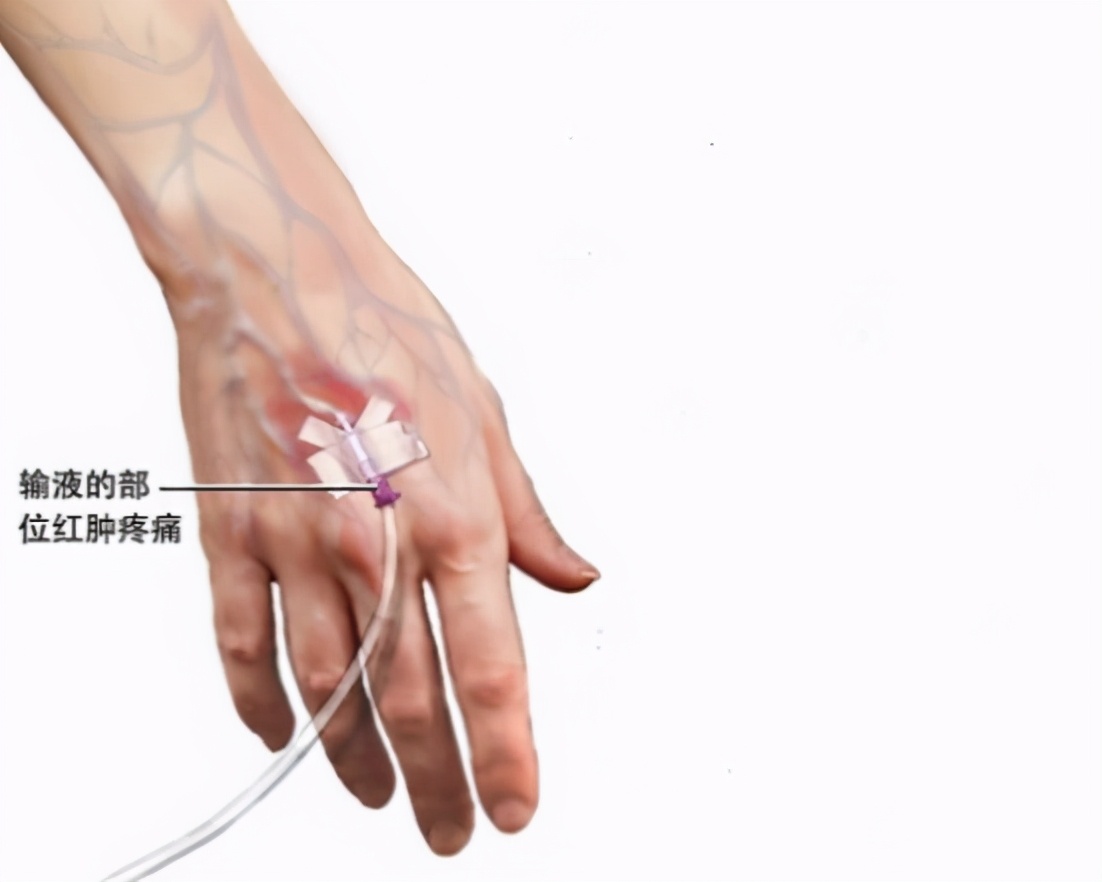 输液过程中痛如何缓解疼痛,输液疼痛缓解办法视频