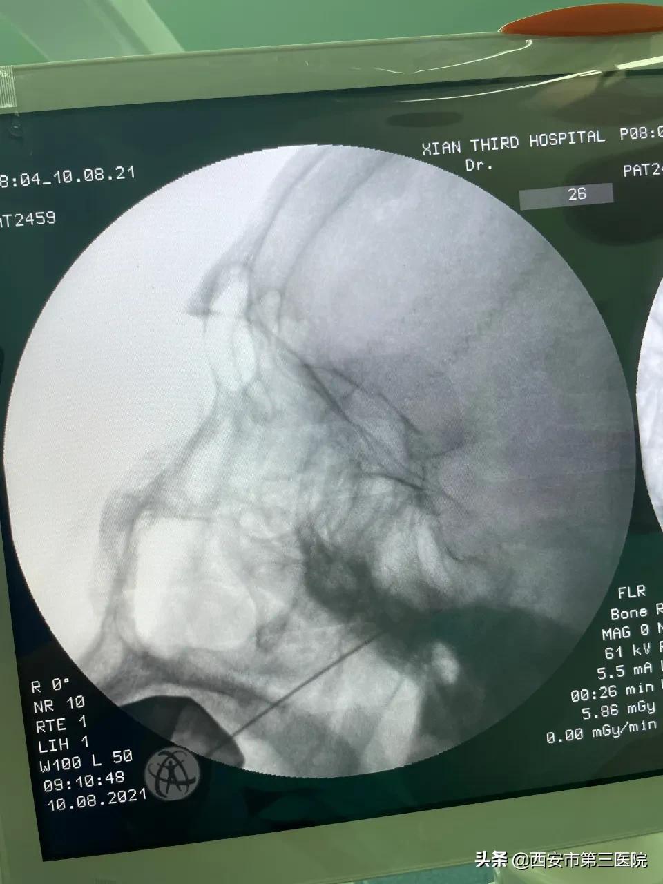 射频消融治疱疹神经疼多久康复,带状疱疹后遗神经痛消融术