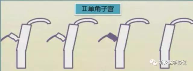 子宫发育异常，应想到的6大类常见畸形