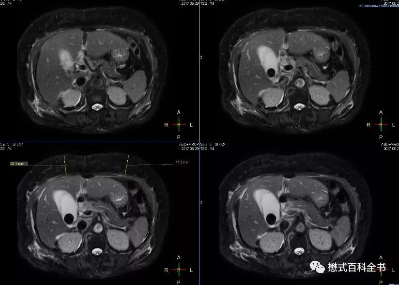 开展mrcp技术,mrcp检查操作流程