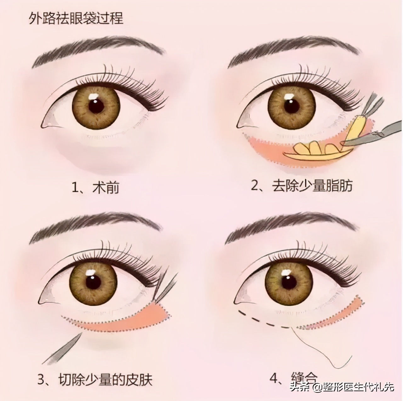 不开刀祛眼袋和开刀祛眼袋哪个好,问一下有什么方法快速消除眼袋