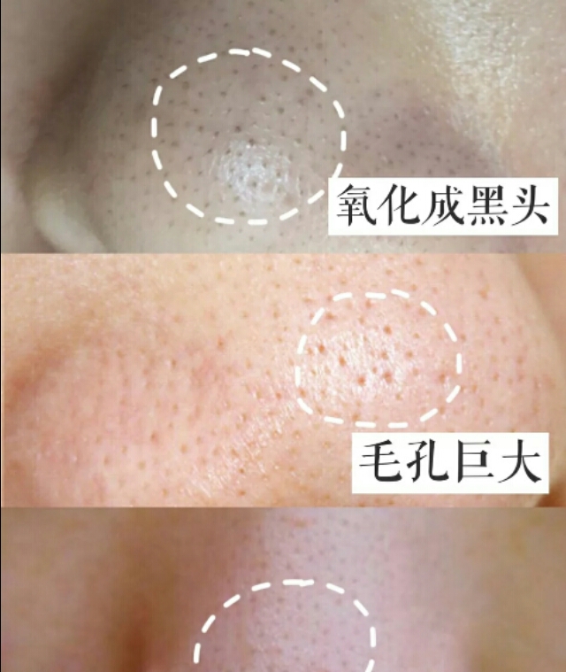 芭贝拉收缩毛孔鼻贴,黑头鼻贴收缩毛孔男
